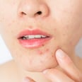 What Is Perioral Dermatitis? 2 Dermatologists Explain the Skin Condition