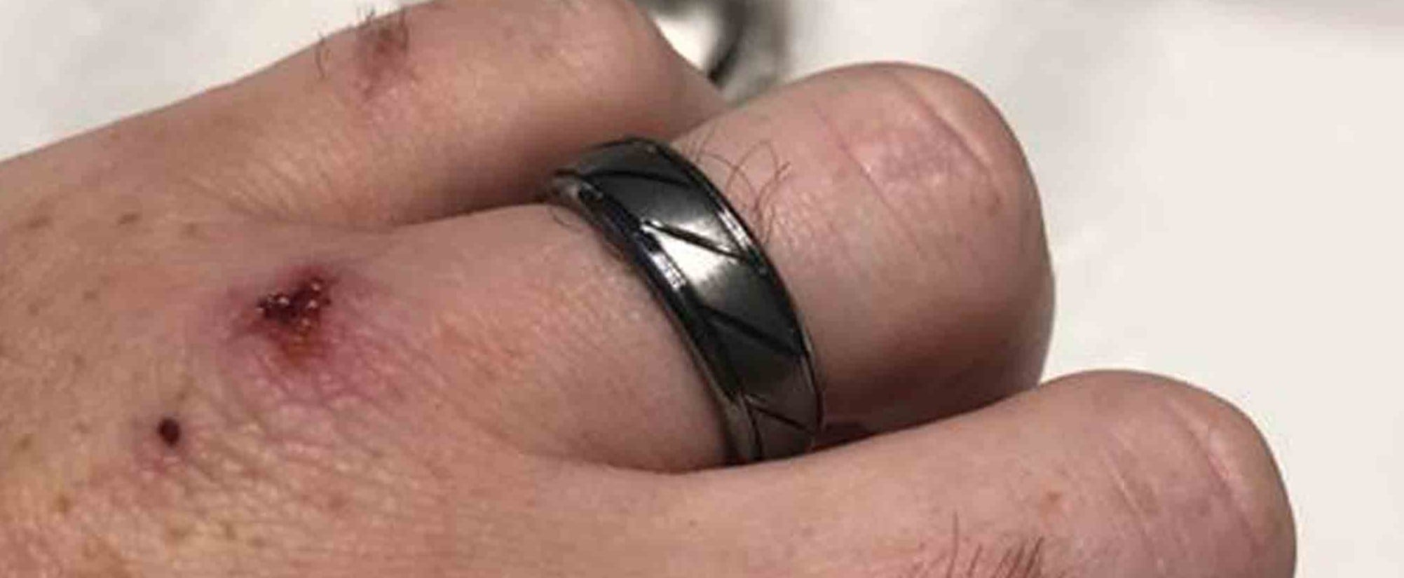 Wedding ring sheathing injury | Honestweddingadvice.com