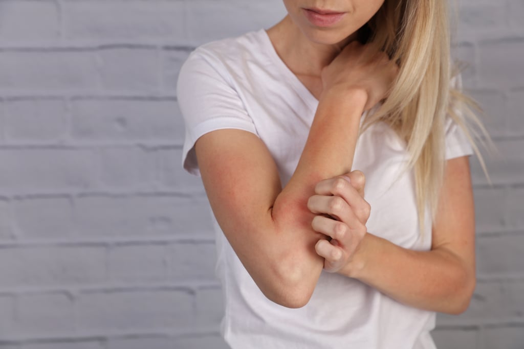 Stop the Eczema Itchiness