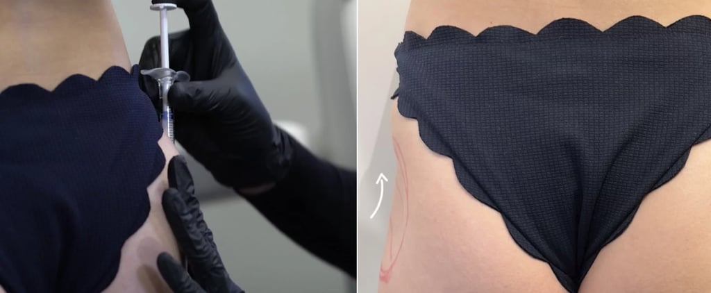 I Got Butt Injections For My Hip Dips: See Photos