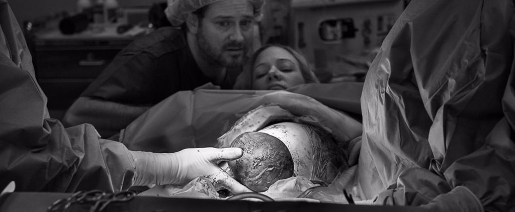 C-Section Mom Watching Baby's Birth