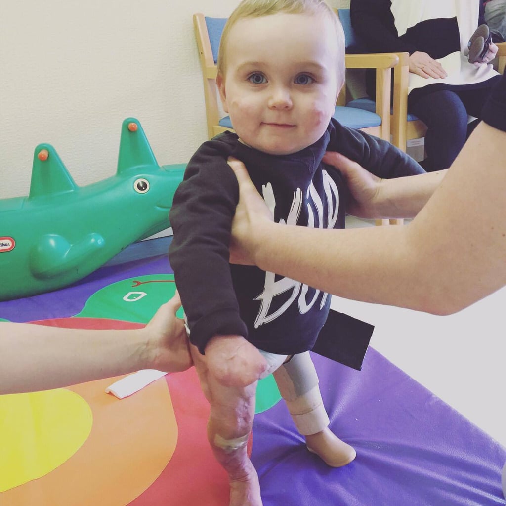 Boy With Amputations From Meningitis Takes First Steps