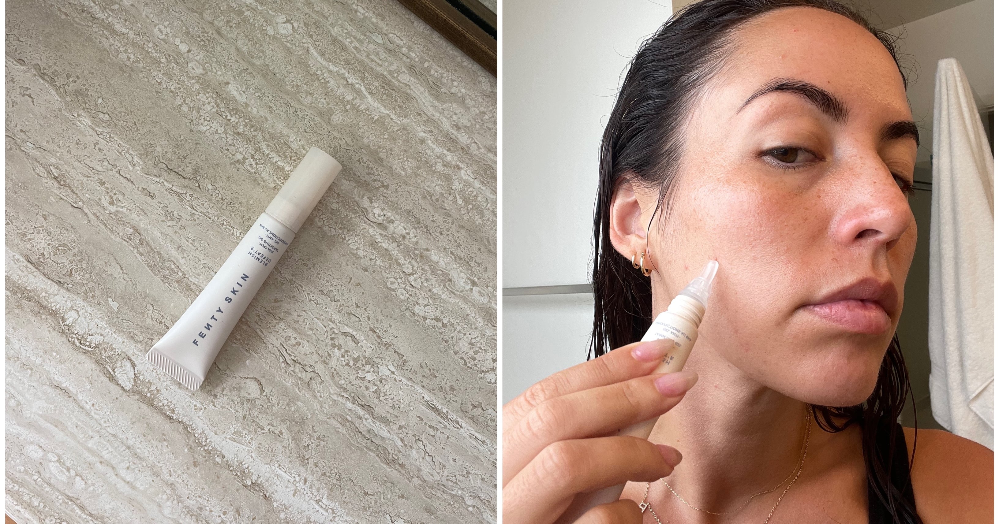 I Can’t Be Without This Viral  Acne Gel