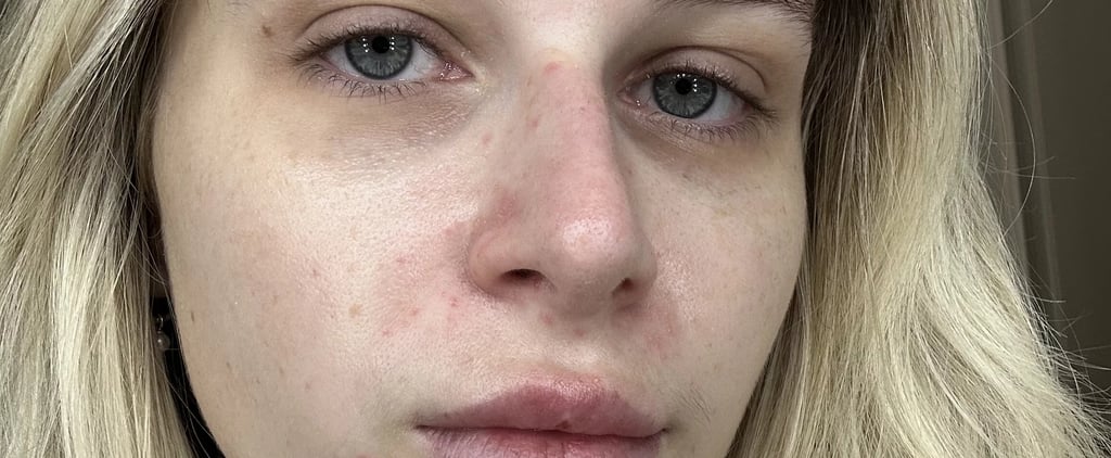 Differin Acne Prone Skin Patches Review With Photos