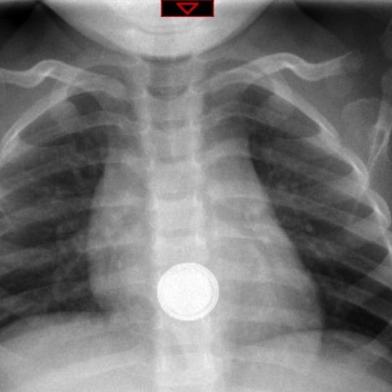 How Dangerous Are Button Batteries?