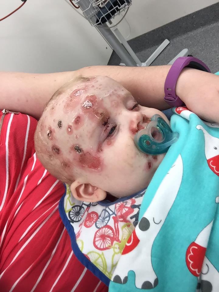 Mom's Plea to Anti-Vaxxers After Baby Gets Chicken Pox
