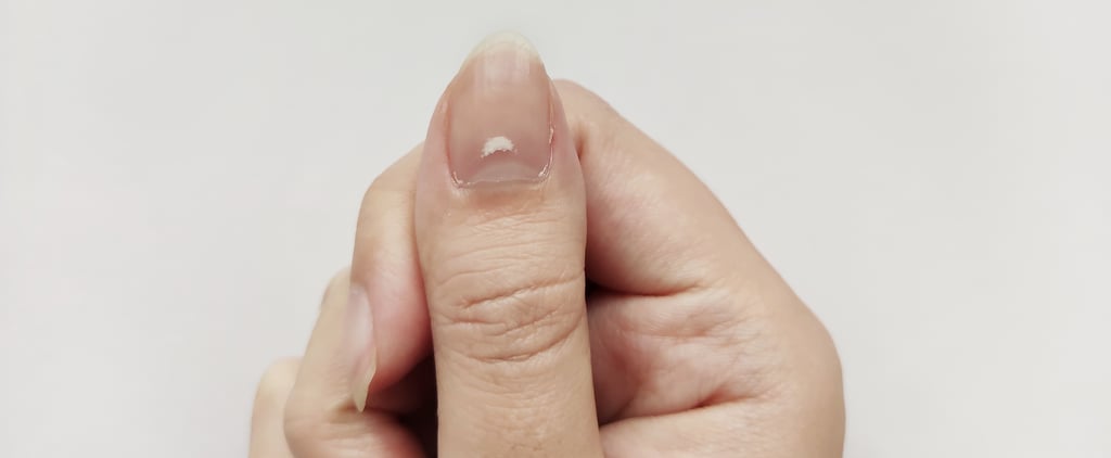 Nails With White Spots: Causes and How to Treat