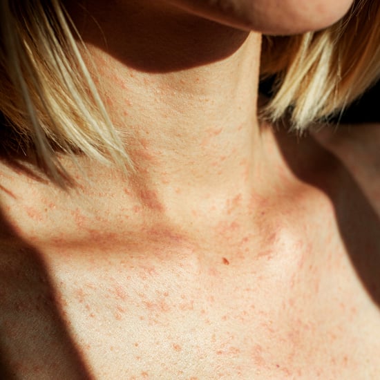 Atopic Dermatitis vs. Eczema: Dermatologists Explain