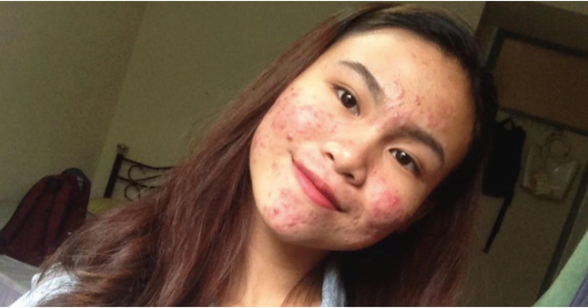 Teen With Severe Acne Posts Bare Face Selfies On Instagram Popsugar