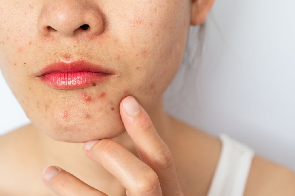 Prescription Products For Acne Popsugar Beauty