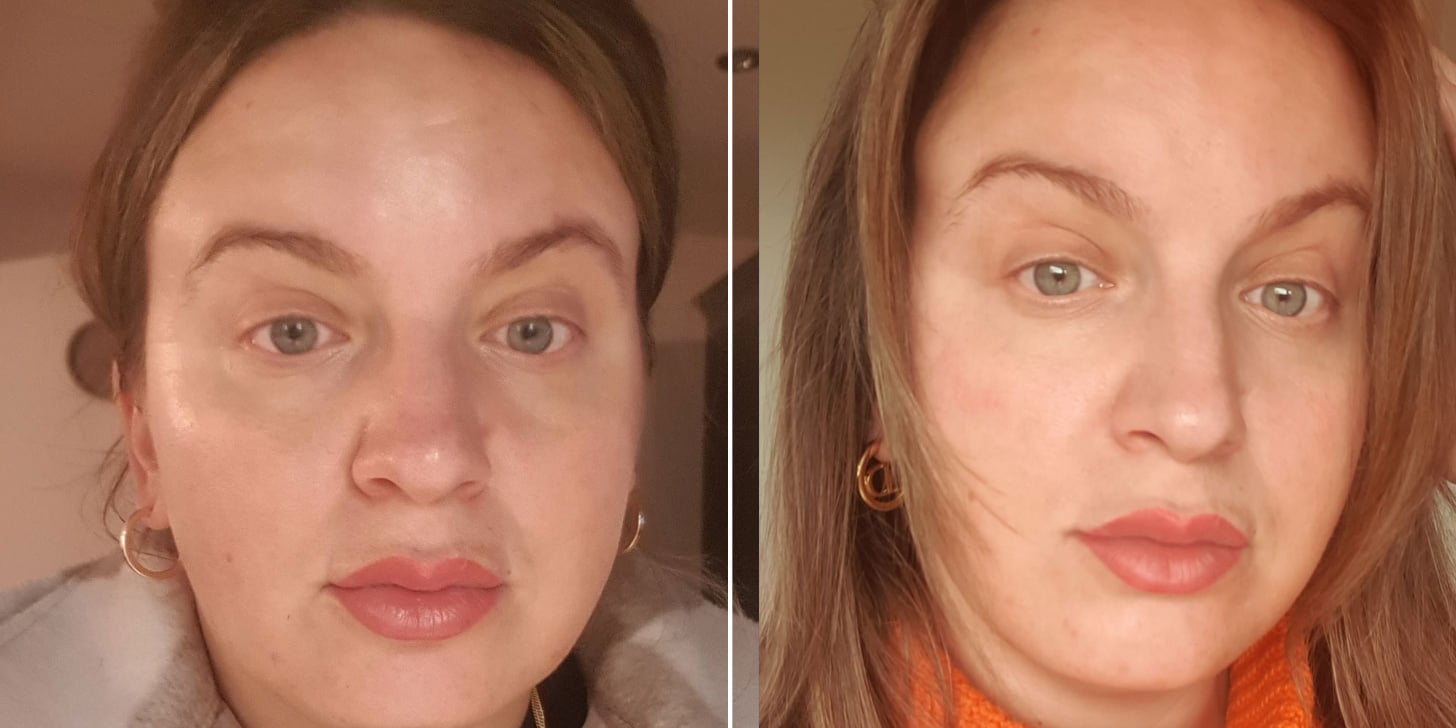 Radiofrequency Microneedling: Before and After Photos