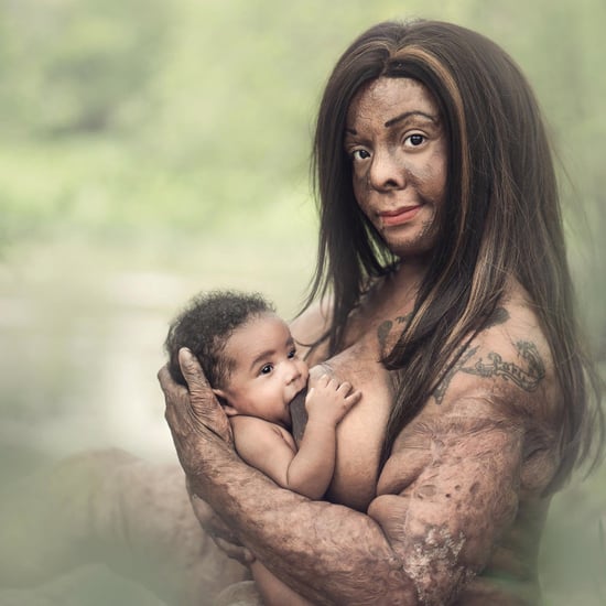 Burn Survivor Breastfeeding