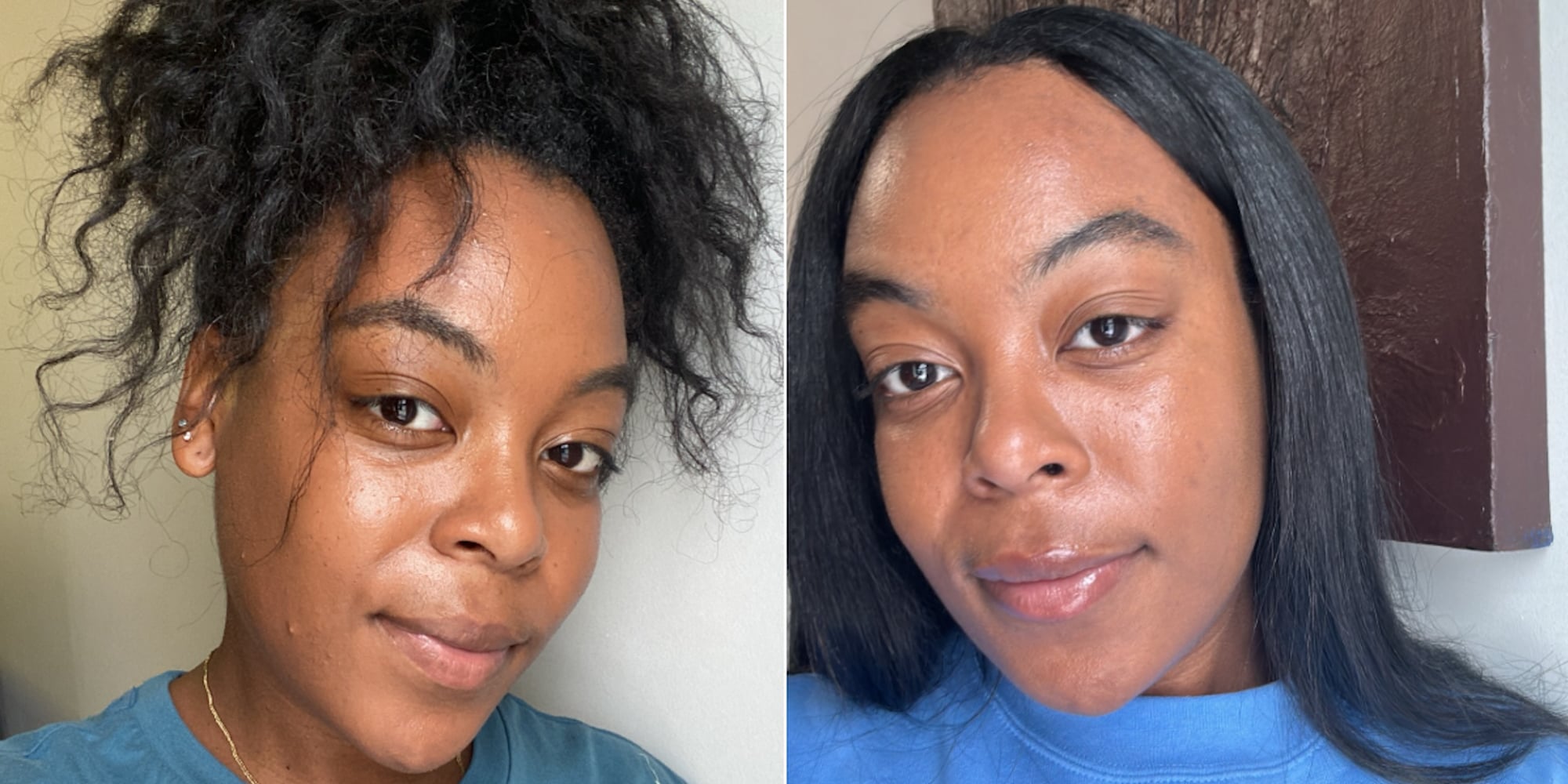Winlevi Before and After: My Experience With the Acne Cream - Vimarsana News