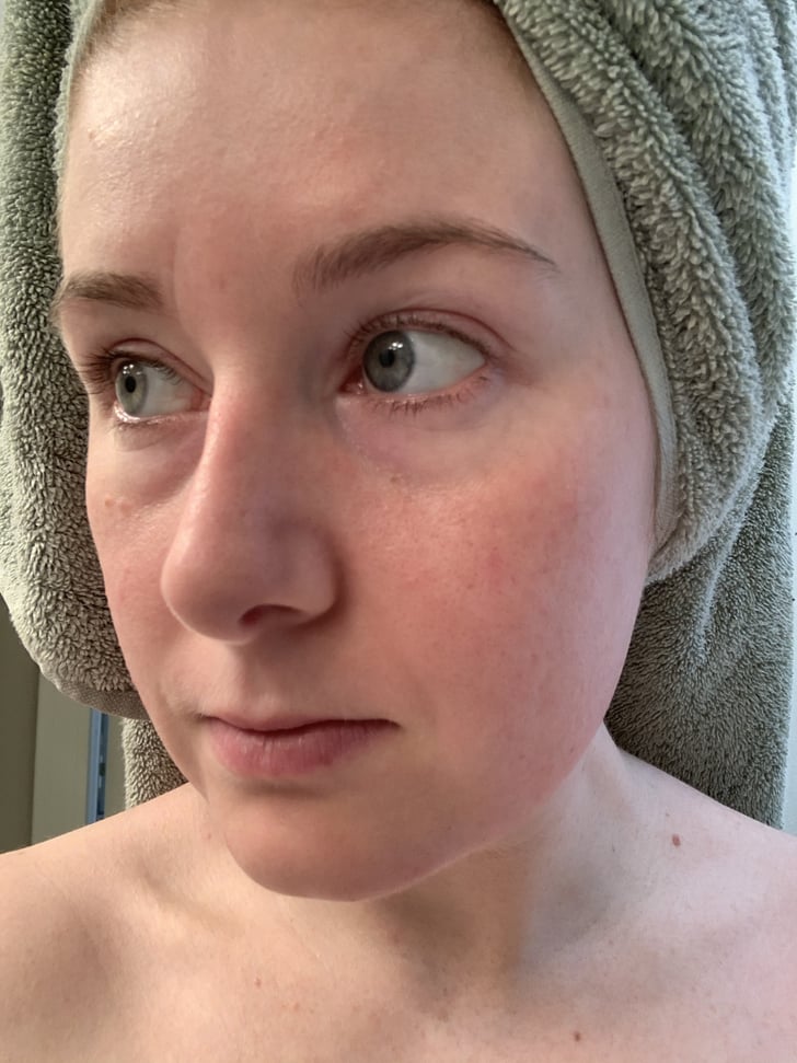 After Using Dermaflash Dermaflash Device Review With Before and After