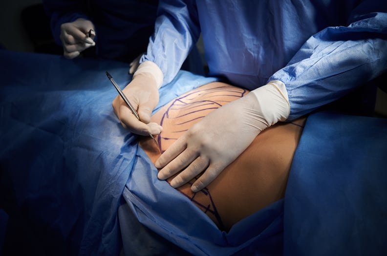 近距离的外科医生的手在白色无菌手套使用手术刀,在手术室做整形手术。外科医生减少病人腹部皮肤上用蓝色痕迹。医学和腹壁整形术的概念。
