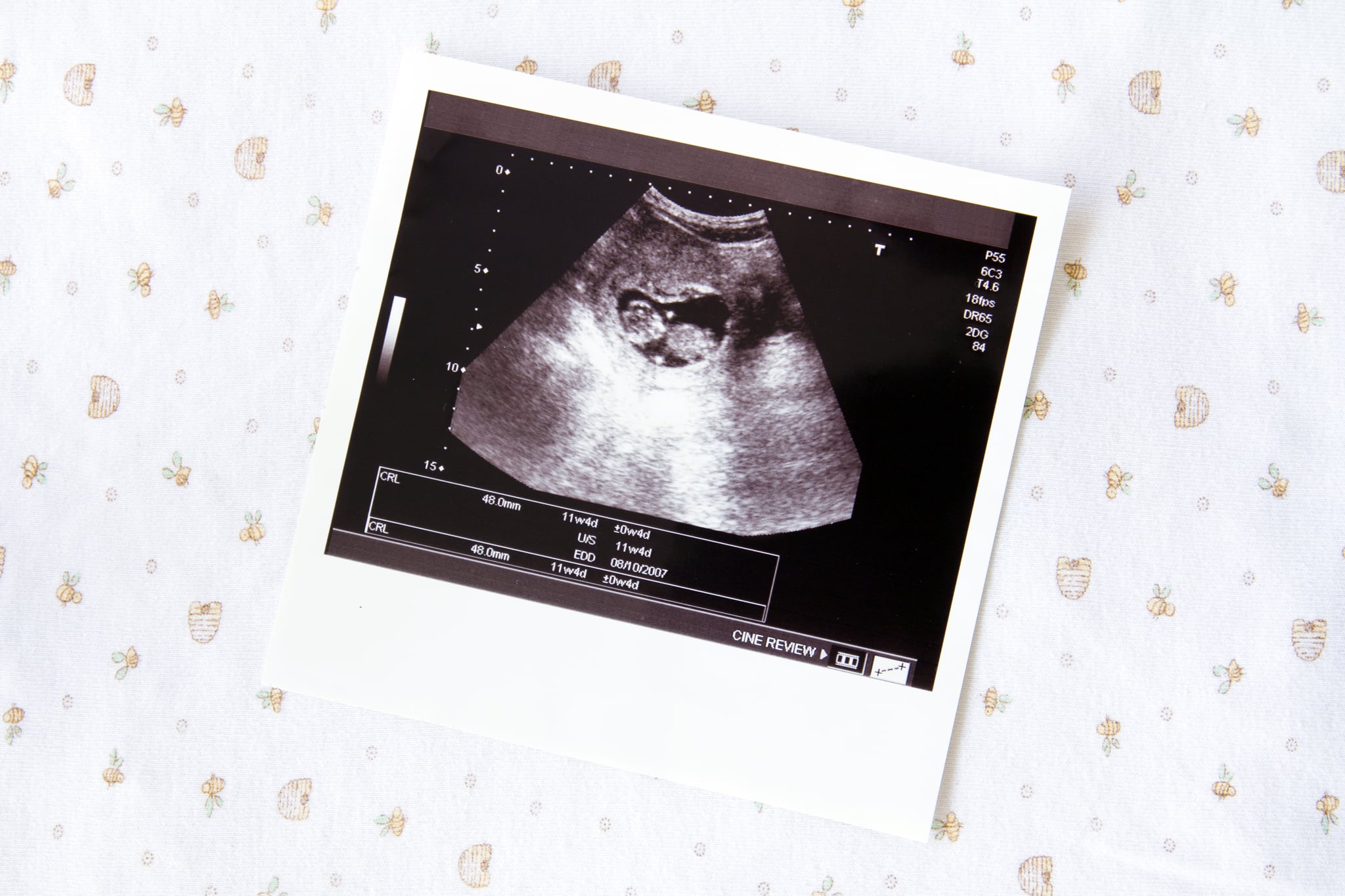 What The Heck Are All Those Letters And Numbers Pregnancy Ultrasounds Are Confusing Popsugar Family Photo 11
