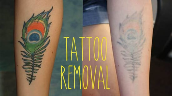 How To Get Rid Of A Tattoo Popsugar Beauty
