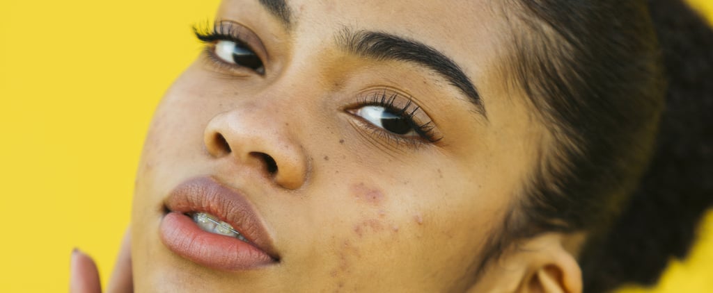 Acne Types: How to Identify and Treat Them