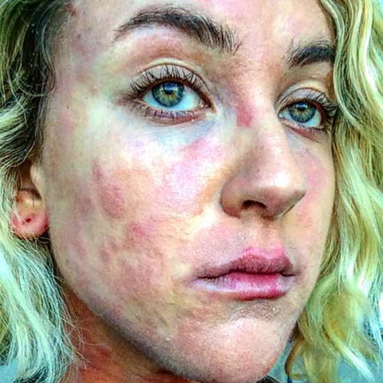 Before and After Photo of Psoriasis