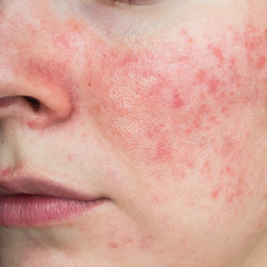 Rosacea Skin-Care Routine, According to Dermatologists