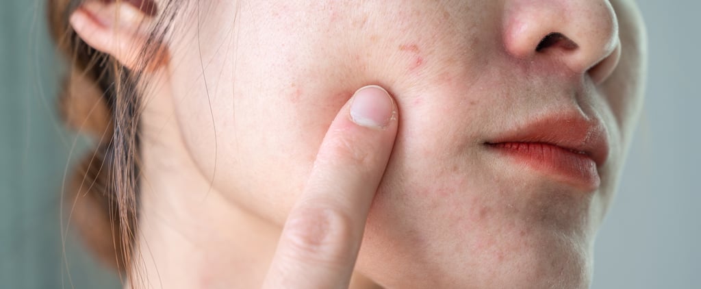 How to Treat Broken Capillaries on the Face