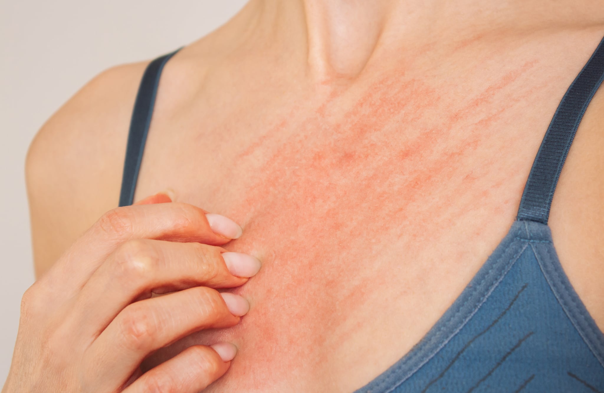 Woman in blue underwear who scratches her breasts and suffers from allergies.