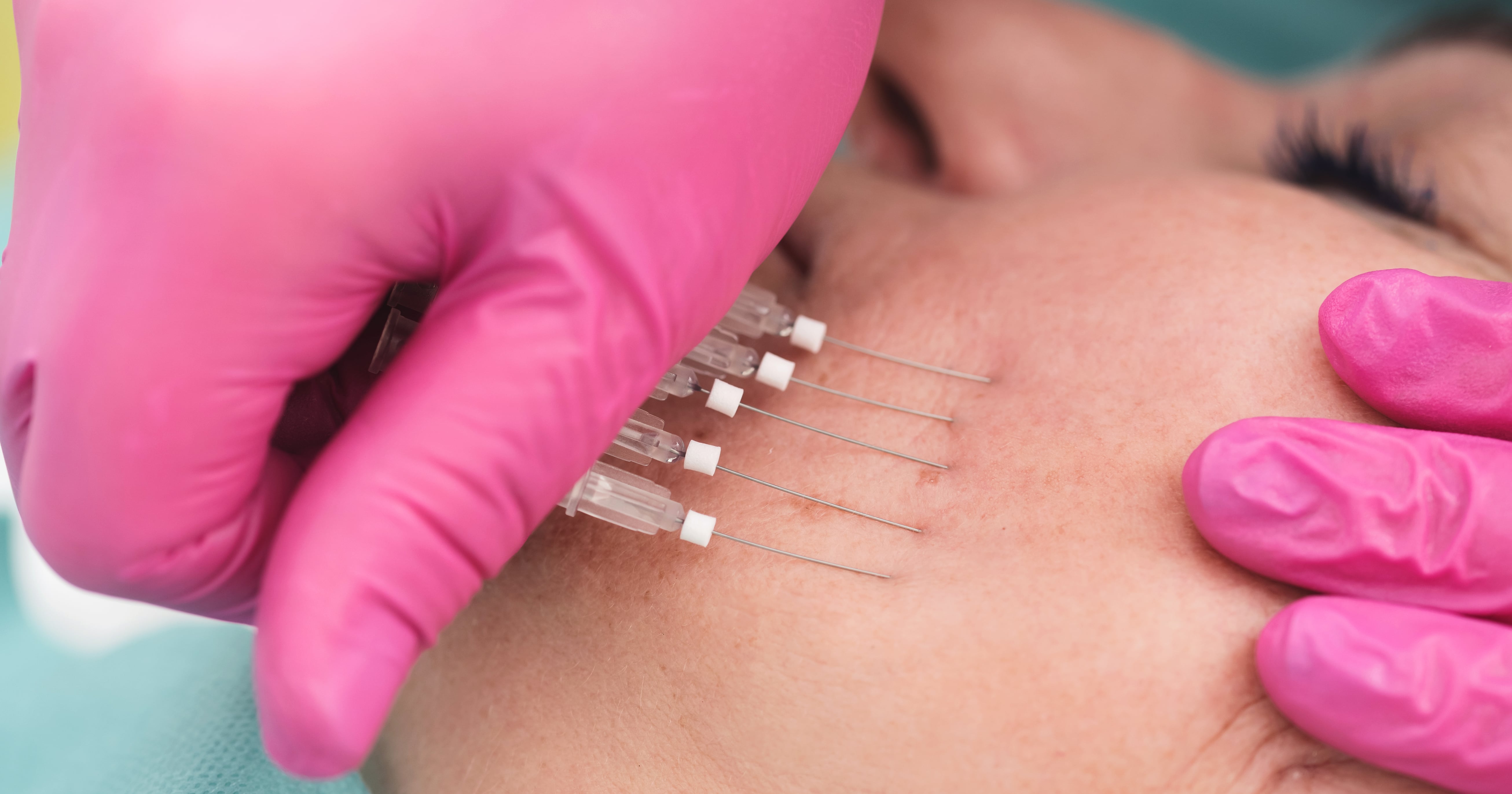 What Are Thread Lifts? POPSUGAR Beauty