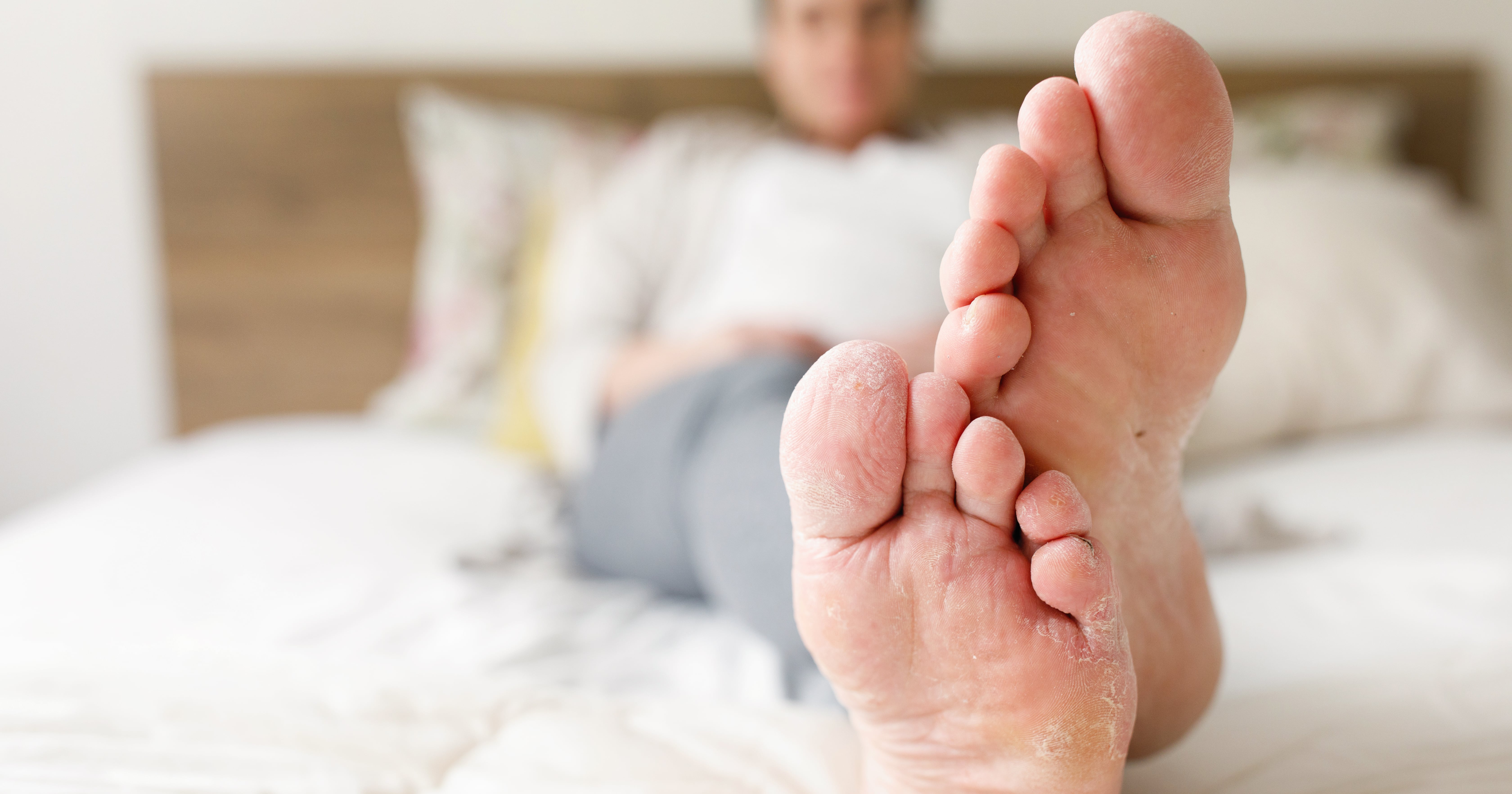 6 Reasons Your Feet Are Peeling So Much, According to Experts
