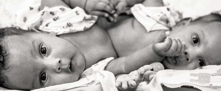 Photographer Captures the Beauty of Conjoined Twins