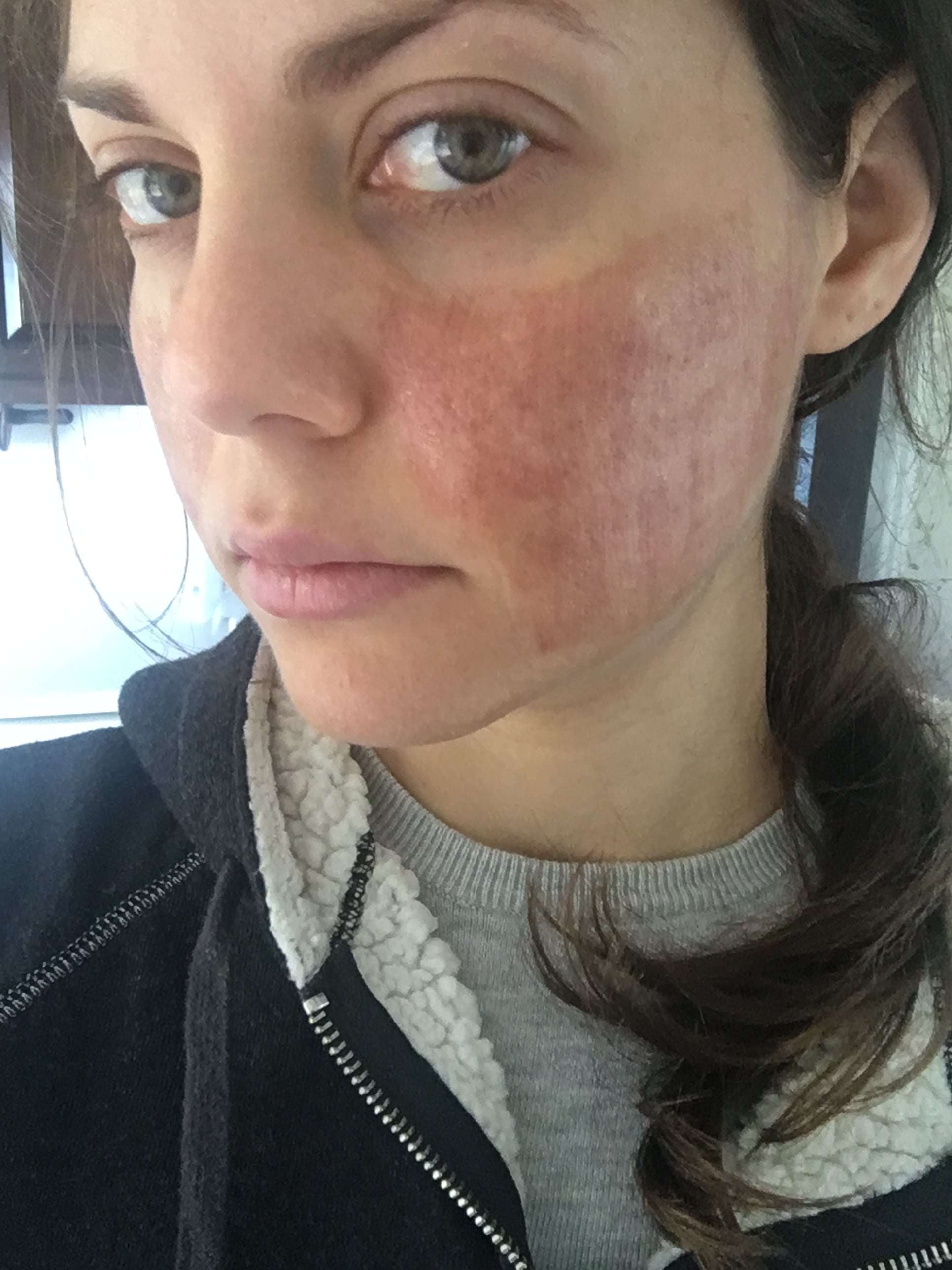 How Co2 Fractional Laser Helped Annie Cleared Acne Scars