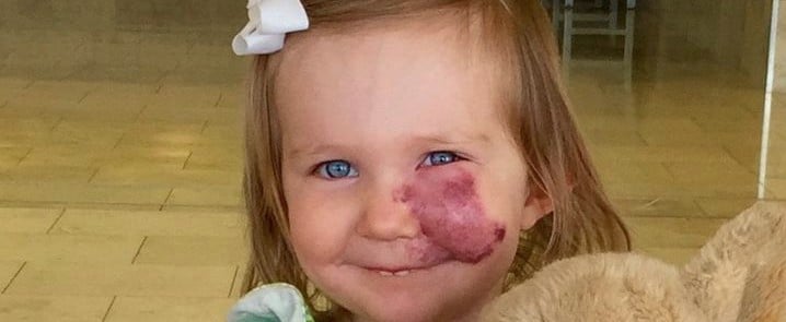 Girl's Reaction to Classmates Staring at Her Birthmark