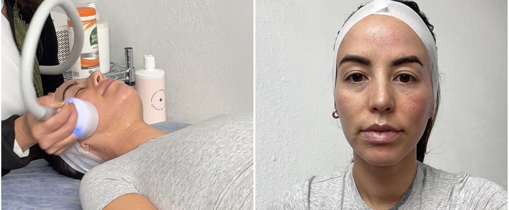 I Got a Cryo Facial: See Before and After Photos