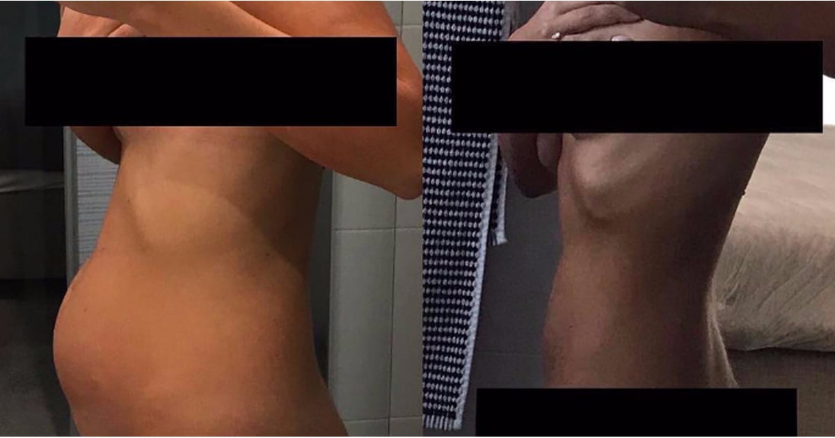 Living With Endometriosis Photos | POPSUGAR Love & Sex pregnant woman stomach diagram 