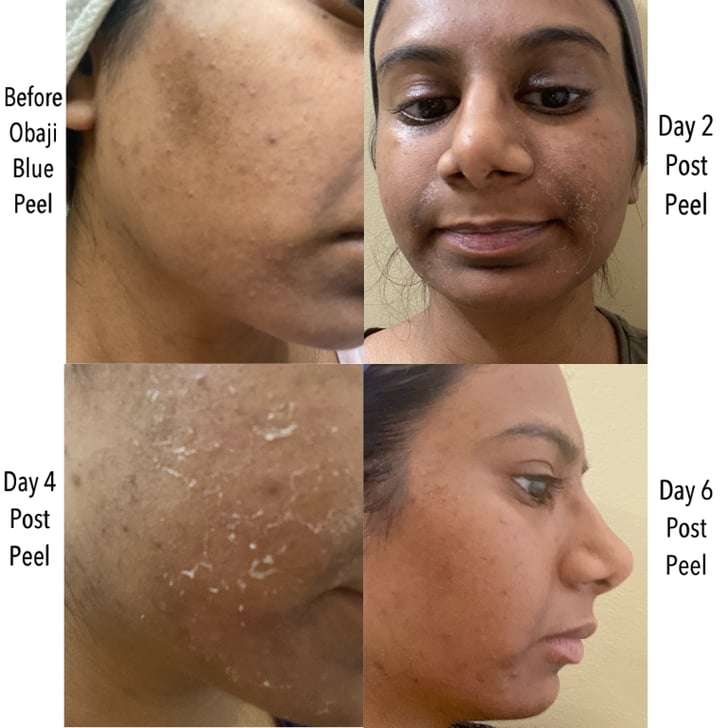 Obagi Clinical Blue Brilliance Triple Acid Peel Obagi Clinical Blue