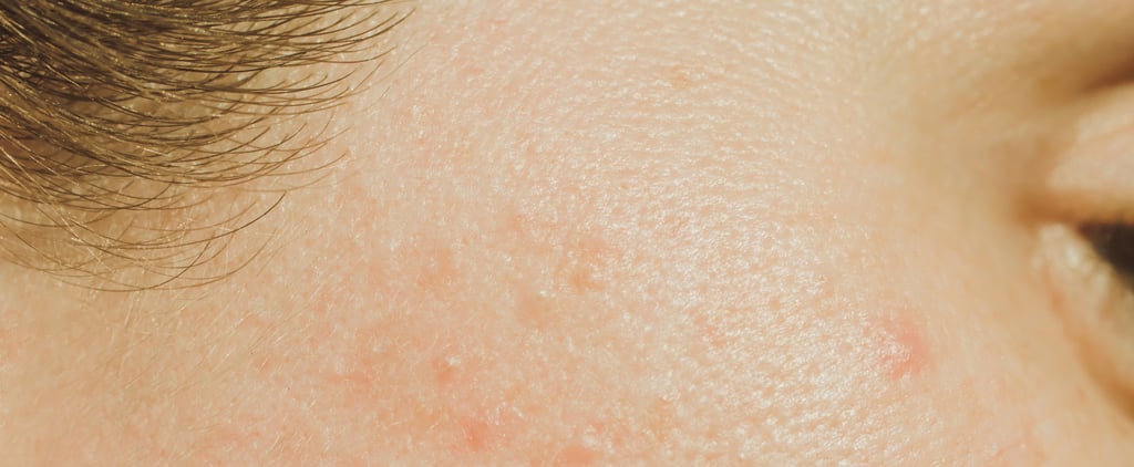 Severe Acne: Types, Treatments, and Tips