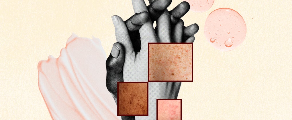 Couples Share How Skin Conditions Impact Their Relationship
