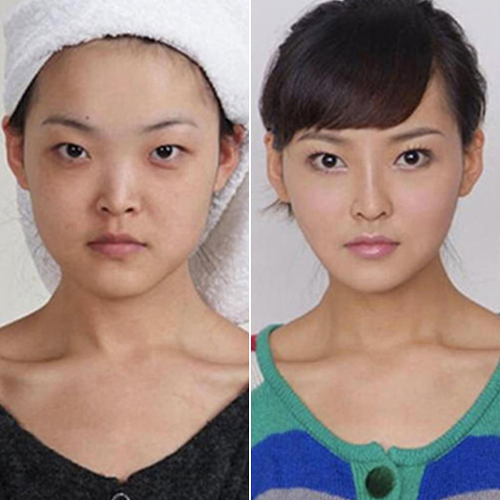 Cosmetic Surgery Before and After. 