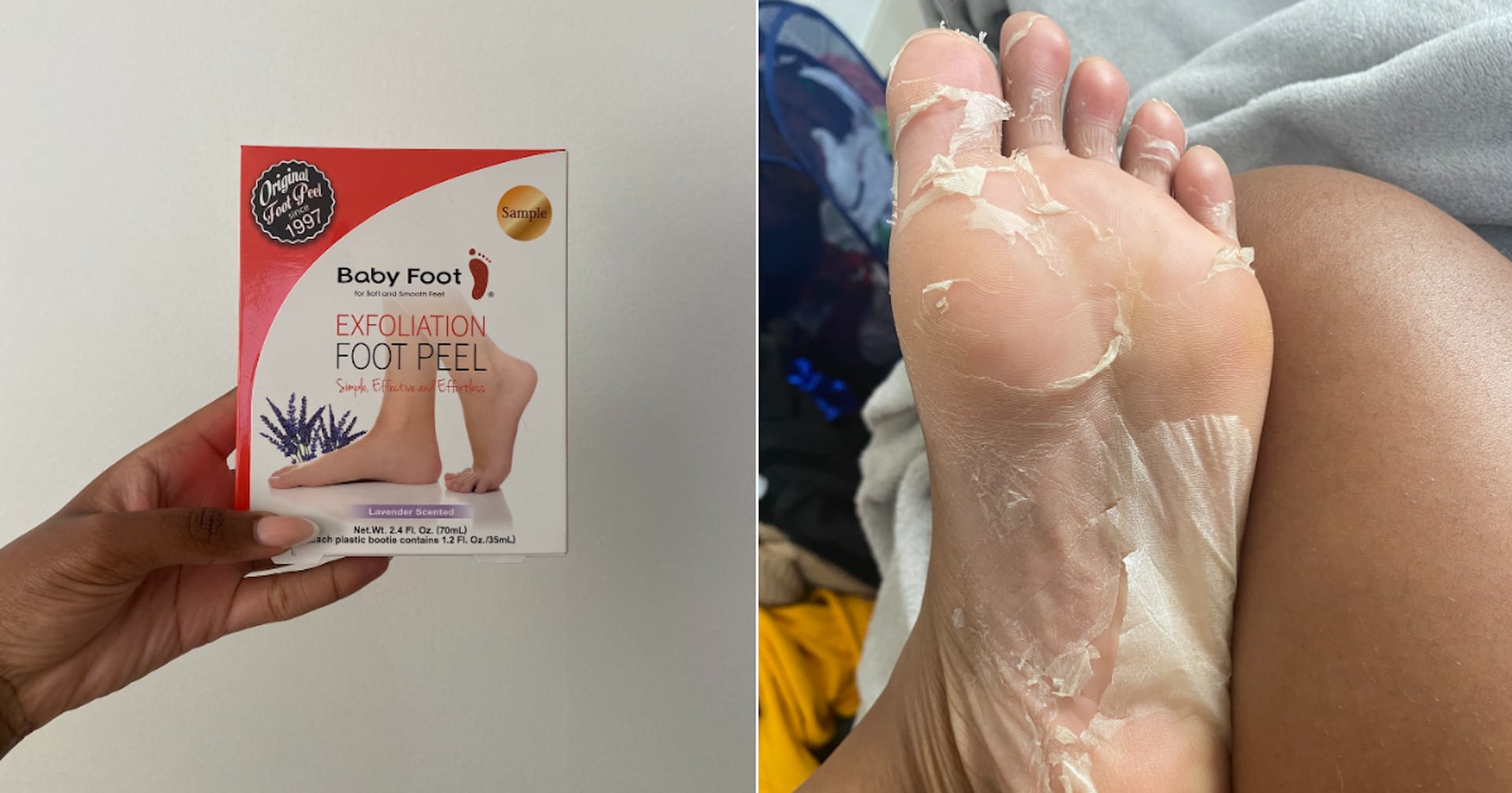 Baby Foot Peel Review With Photos