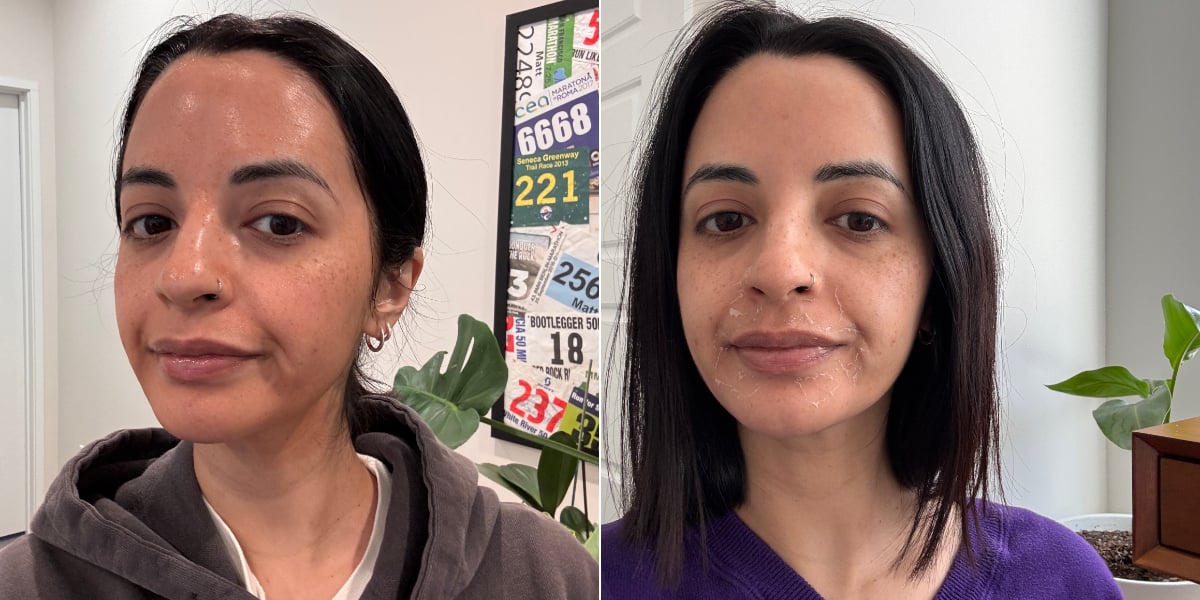 I Tried a Chemical Peel For Acne and Dark Spots — Now, It’s My Holy Grail