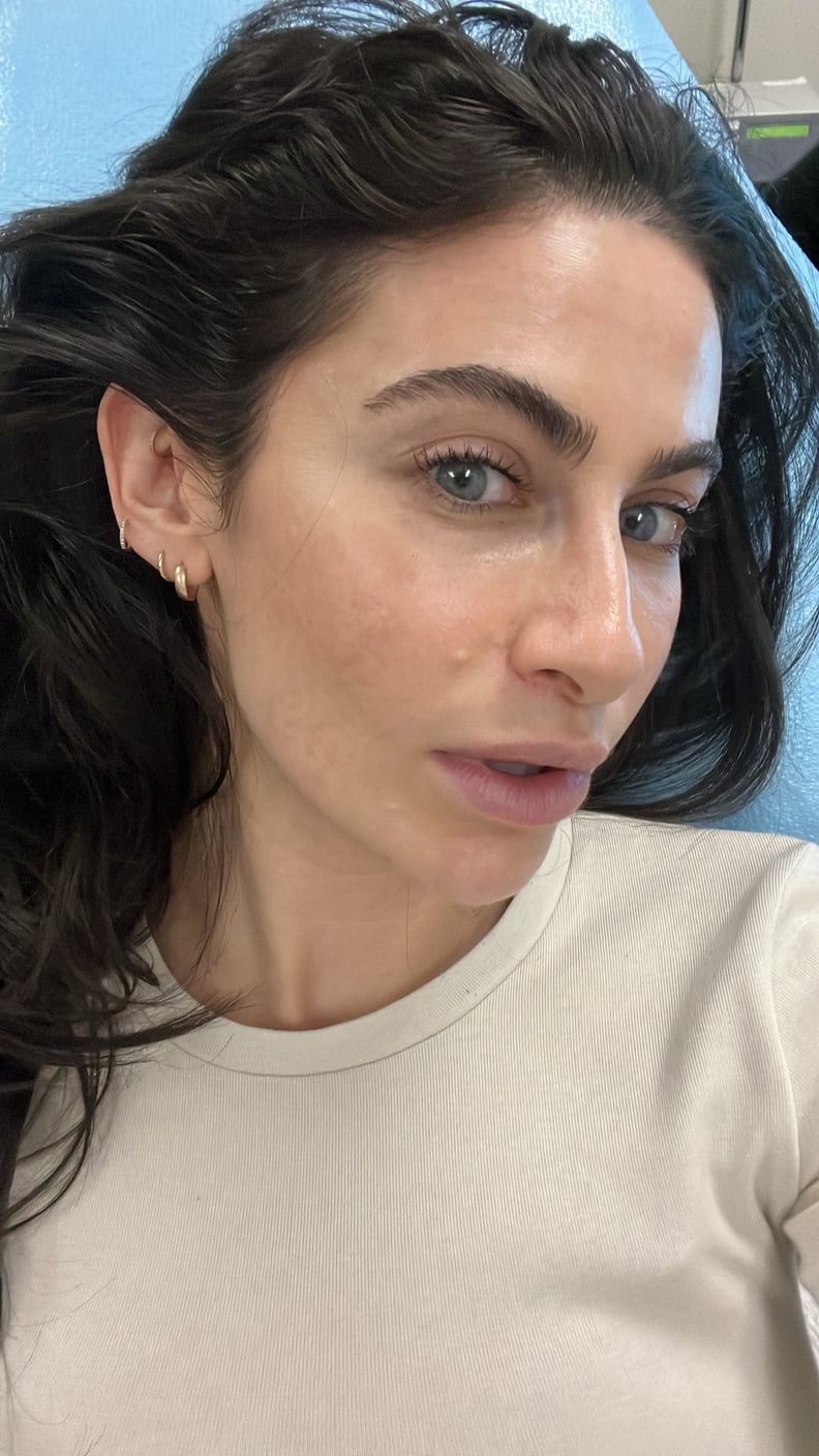 I Attempted the Noninvasive Hair Loss Remedy Alma TED, and It In point of fact Labored