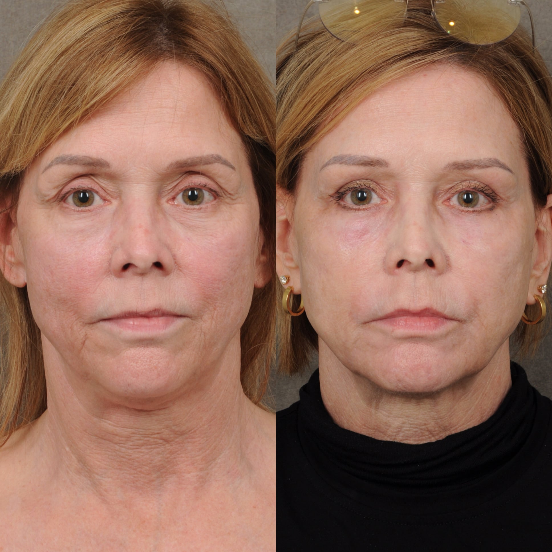 Upper Bleph, RF Microneedling, PHAT by Dr. Ben Talei