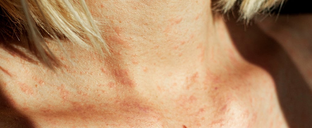 Hives vs. Rash: Experts Explain the Differences