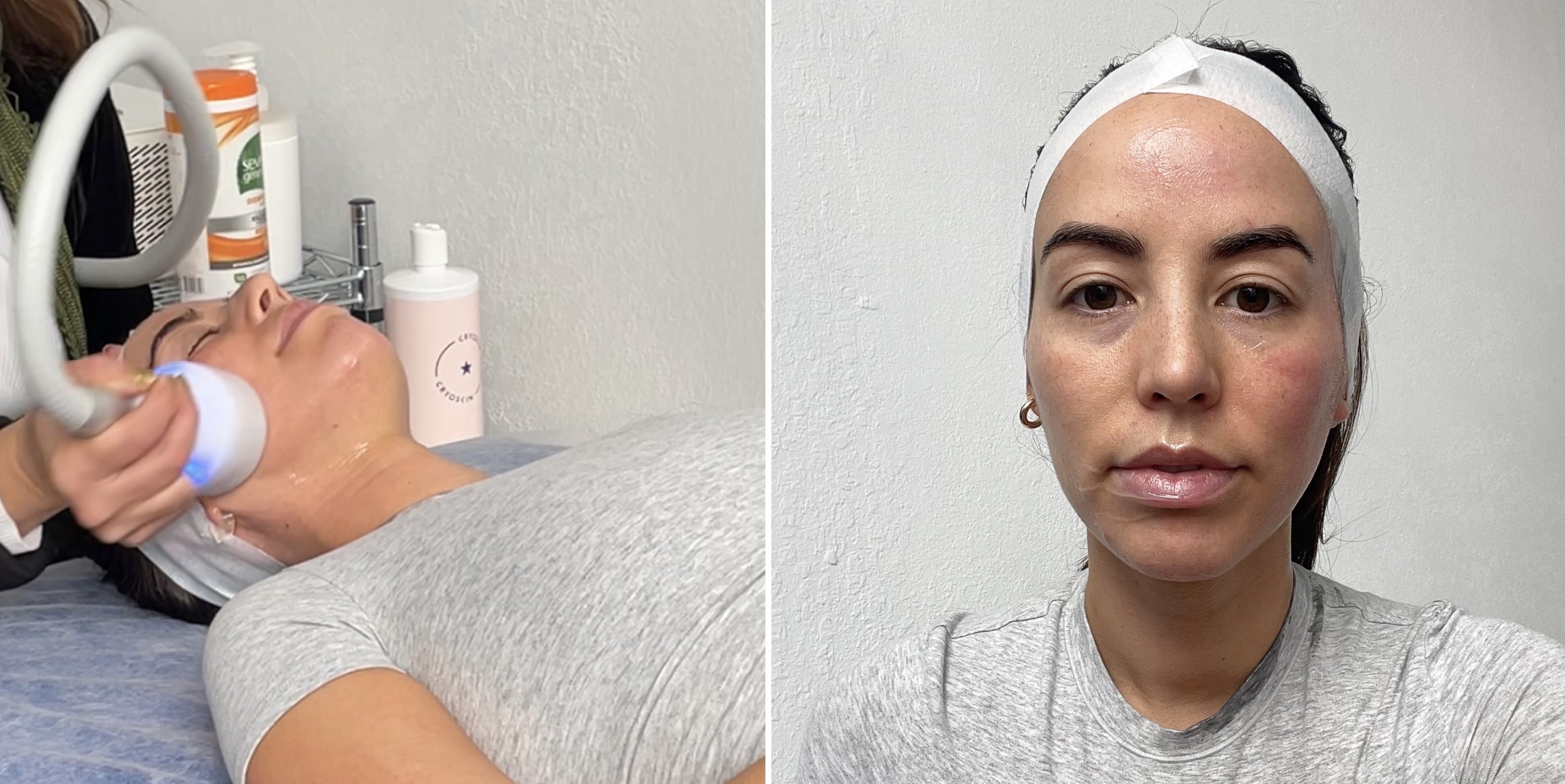 I Got a Cryo Facial See Before and After Photos POPSUGAR Beauty