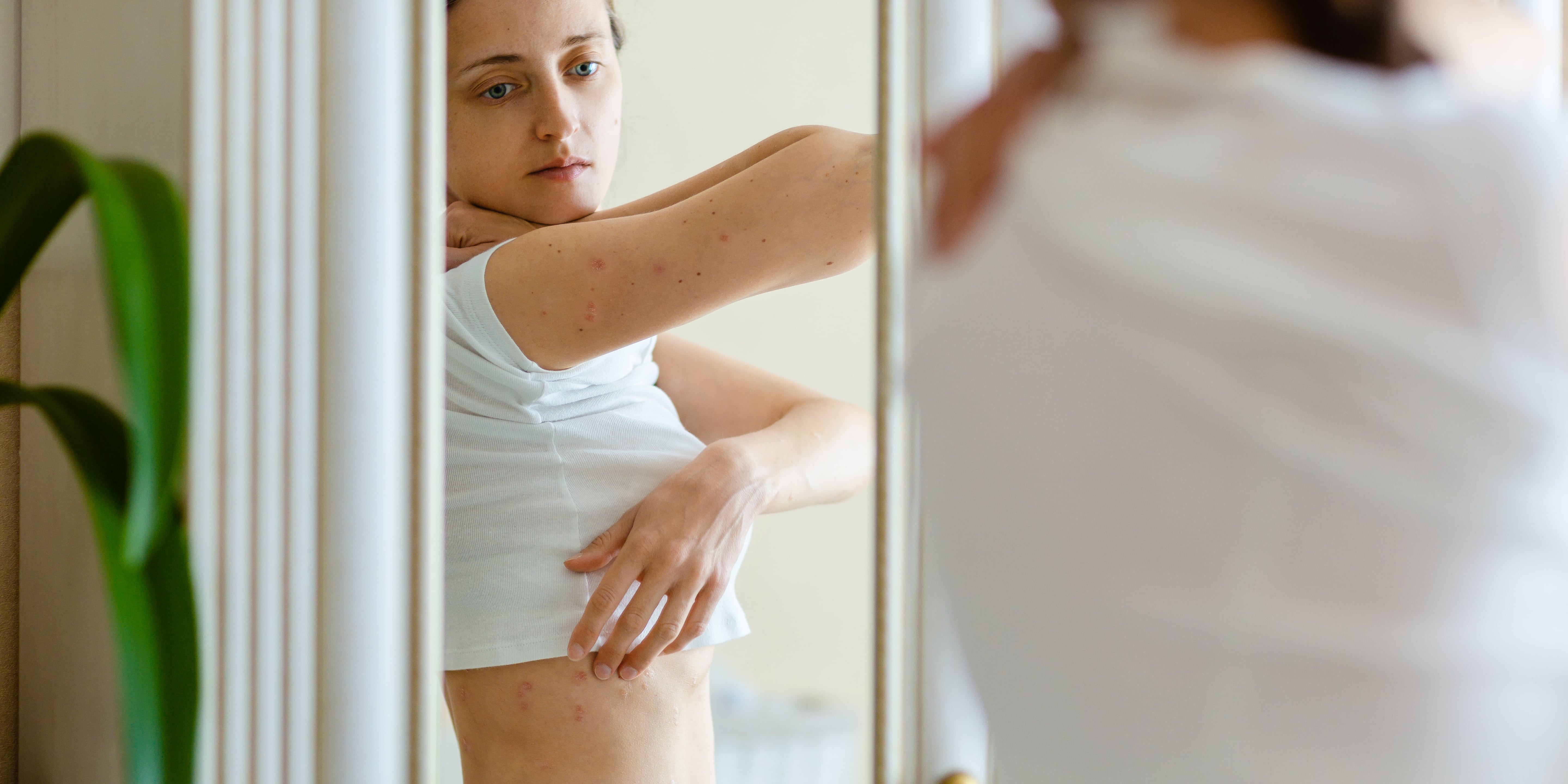 What Is Eczema and How Can You Treat it? - Vimarsana News