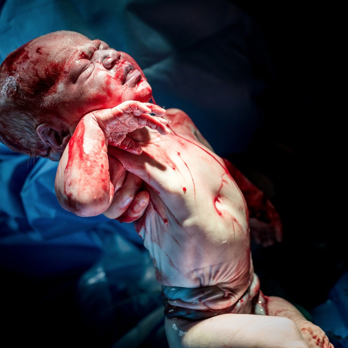 Baby Born With Umbilical Cord Wrapped Around Her Stomach ...