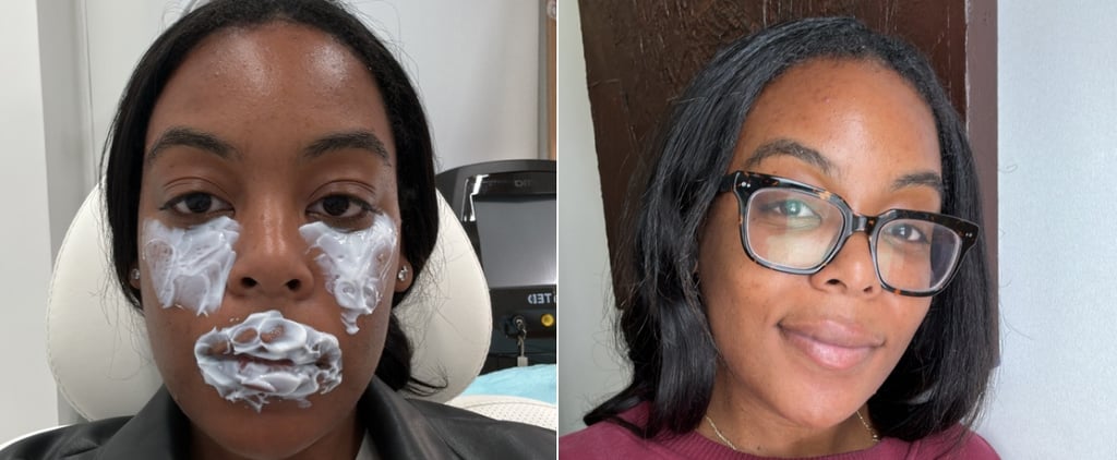 I Tried Restylane Eyelight Undereye Filler: Review, Photos