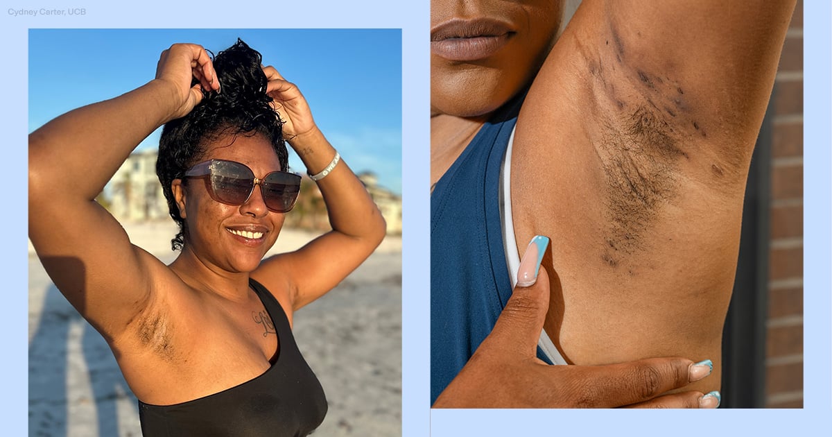 How I Learned to Love My Bumps and Scars From Hidradenitis Suppurativa