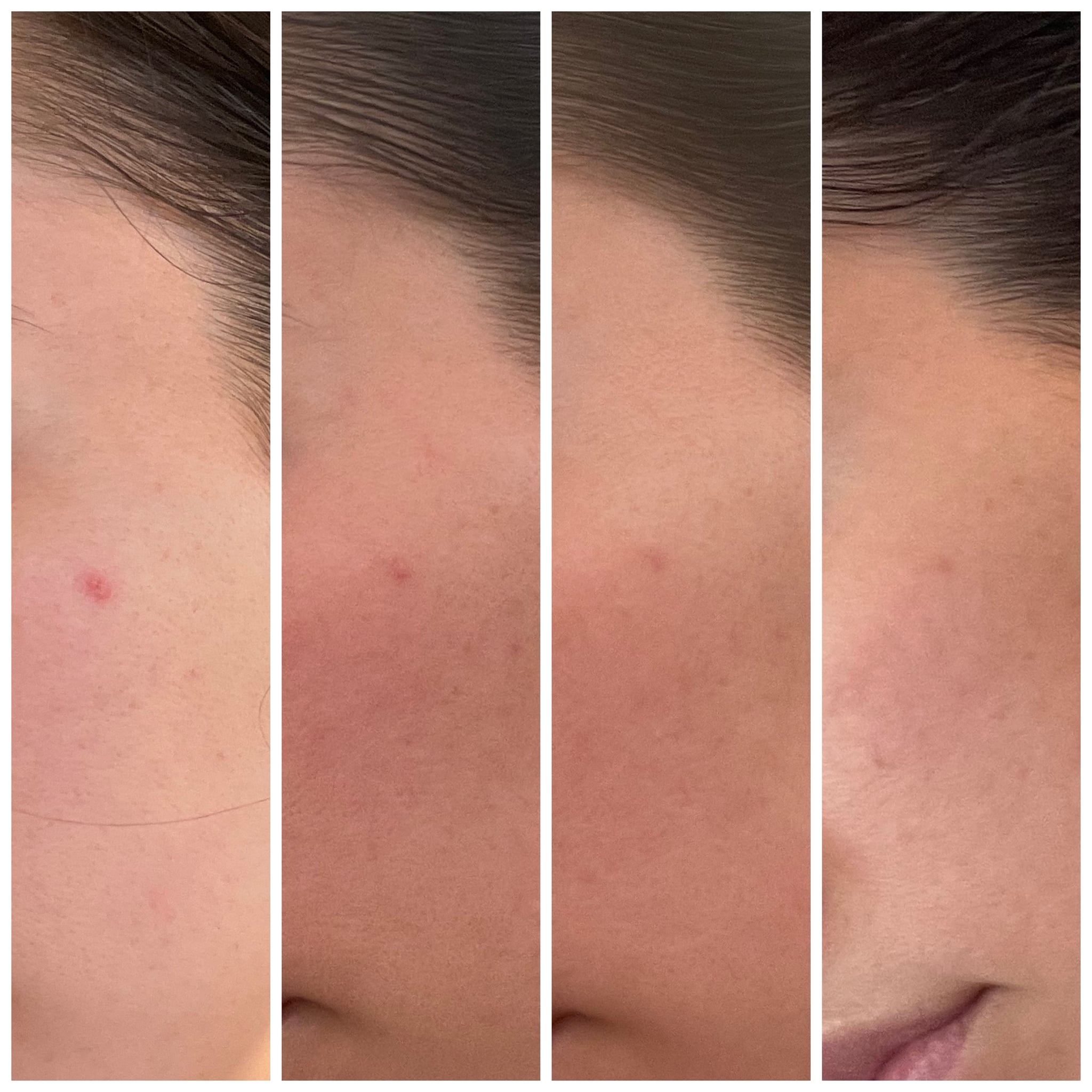 ERADIKATE ACNE MARK FADING GEL BEFORE AND AFTER