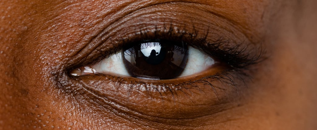 Dermatosis Papulosa Nigra, Explained by a Dermatologist