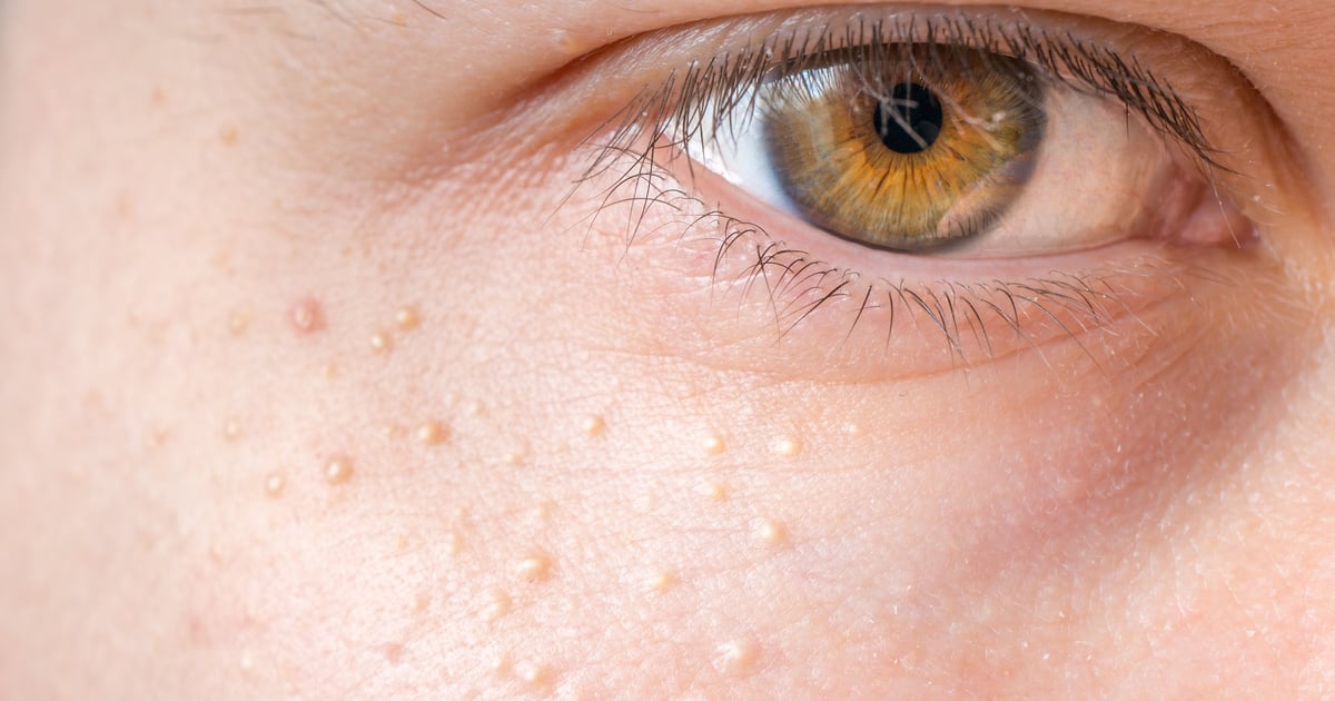How to Treat Milia, According to Experts